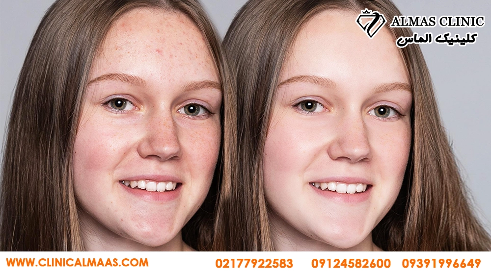 روشن‌تر شدن پوست با میکرونیدلینگ ترکیبی